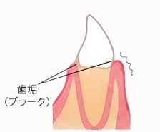 歯肉炎の状態
