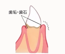 軽度歯周炎の状態