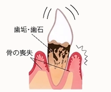重度歯周炎の状態