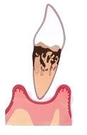 抜歯